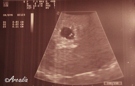 Echo 5 weken zwanger